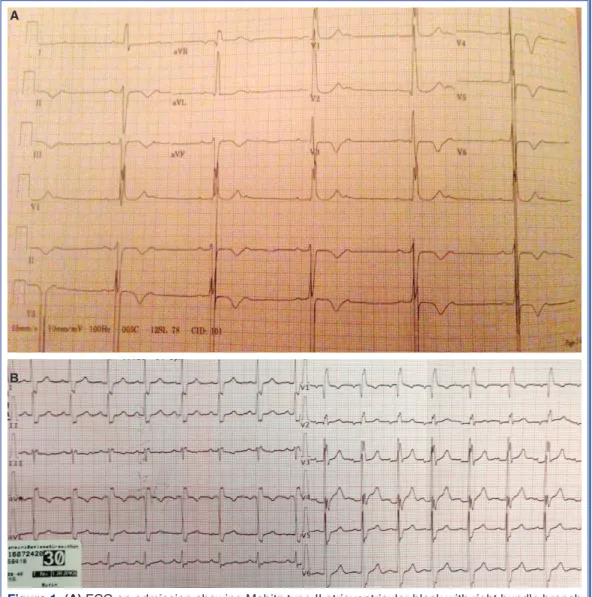 Figure 1. (A) ECG on admission showing Mobitz type II atrioventricular block with right bundle branch  block, left anterior hemiblock, and T-wave inversions in leads V4 through V6