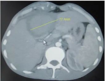 Figure 1. Computerized tomography image of the abdo- abdo-men: An  isodense  lesion  85x75  mm  in  diameter  with  a  thick and irregular capsule, and invasion of the overlying  ribs which had no contrast enhancement