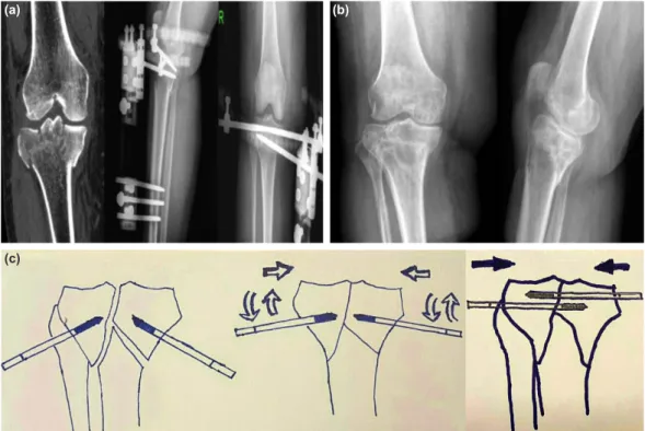 Figure 2. (a) Preoperative coronal view computed tomography of a 63-year-old female patient and postoperative  antero-posterior and lateral images of the tibia