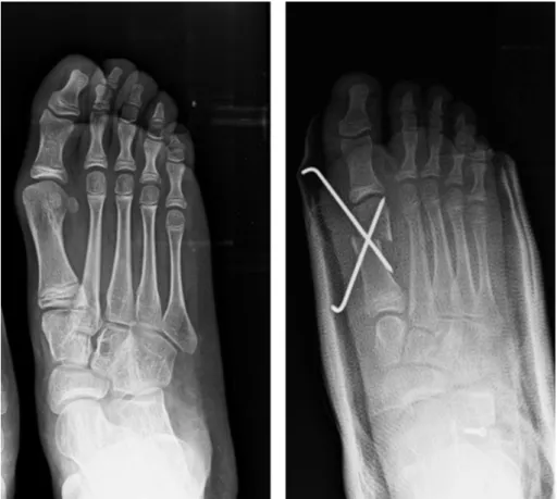 Fig. 1. Preoperative and postoperative radiographs of a patient.