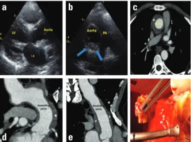 Figure 1. (a,b) Parasternal long and short-axis images showing thick- thick-ened aortic wall (blue arrows) starting just above aortic valve (c,d,e)  CT image showing circular thickened aortic Wall (*) extending from  aortic valve level to aortic arch and m