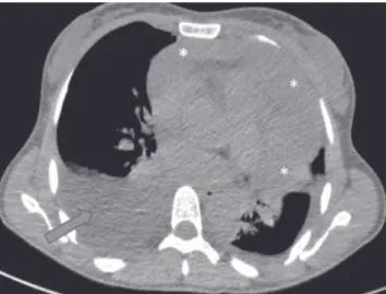 Figure 1. Chest X-Ray of the antero-posterior view shows a cardio thoracic  index > 0.5 and bilateral pleural effusion (arrow).