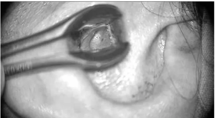 Figure 1.  Skin-colored,  verrucous,  papillomatous  lesion 
