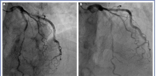 Figure 1. (A) Diastolic phase of coronary flow, (B) Systolic phase of coronary flow; arrows show systolic com- com-pression at mid part of left anterior descending artery.