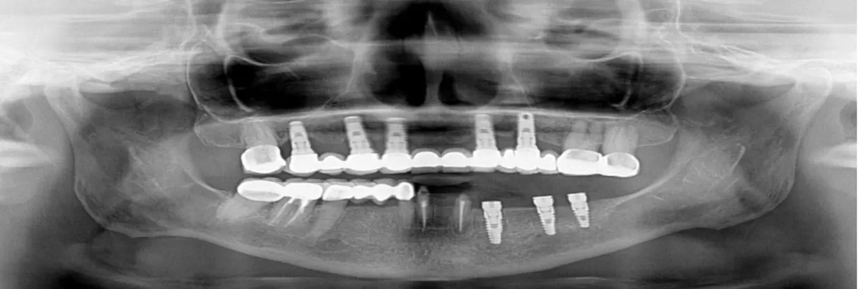 Figure 1. Panoramic radiograph of the patient prior to treatment.