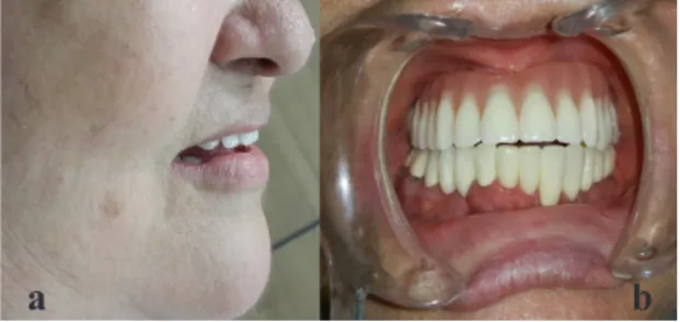 Figure 4. Delivery of definitive maxillary screw-retained  hybrid prosthesis: Lateral profile view of the patient (a)  and final occlusion (b).