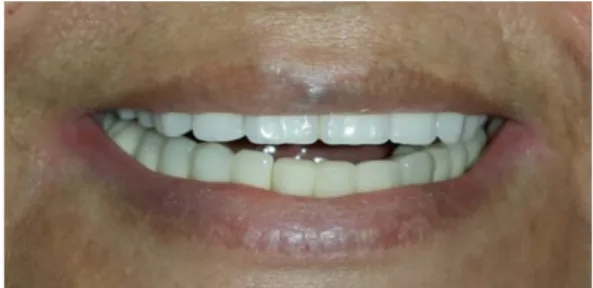 Figure 6. Clinical image of the patient smiling after one  year follow-up period.