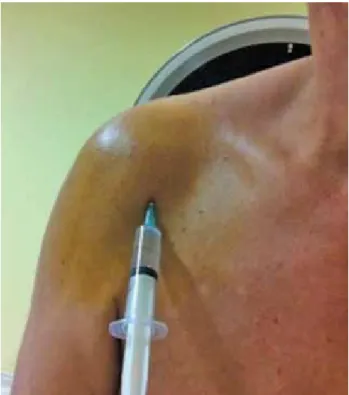 Figure 1. Intra-articular shoulder injection. Injections were  performed with anterior approach.