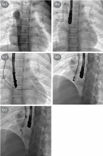 Figure 3. Diagram of 29 patients undergoing Kawashima procedure.