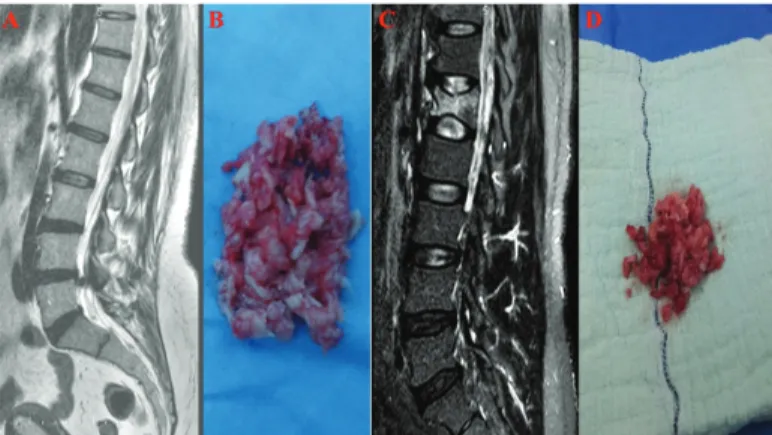 Figure 1. a-d. Sagittal (a) T2-weighted MR images show L4-5  sequestrated  intervertebral  disc  herniation,  (b) degenerated  intervertebral disc tissue resected after lumbar microdiscectomy  from  this  case,  sagittal  (c)  T2-weighted  MR  images  show