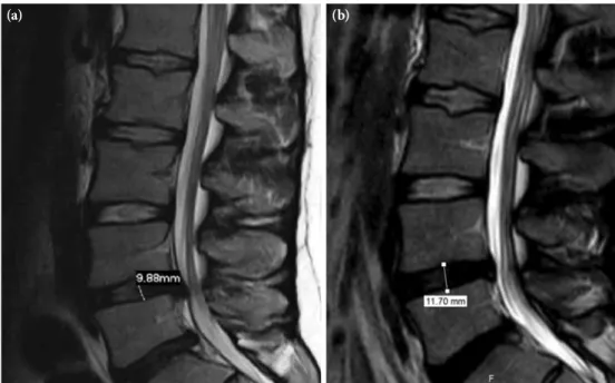 Figure 1. Sagittal T 2 -weighted magnetic resonance imaging of the lumbar spine shows L4-L5 disc  herniation with caudal migration (a) and (b) resorption in the second image