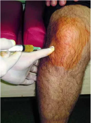 Fig. 1. PRP injection to the knee from the anterolateral  portal.