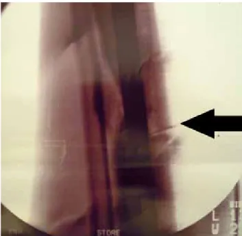 Fig. 3. PRP administation with flouroscopic guidence. Black  arrow shows needle.