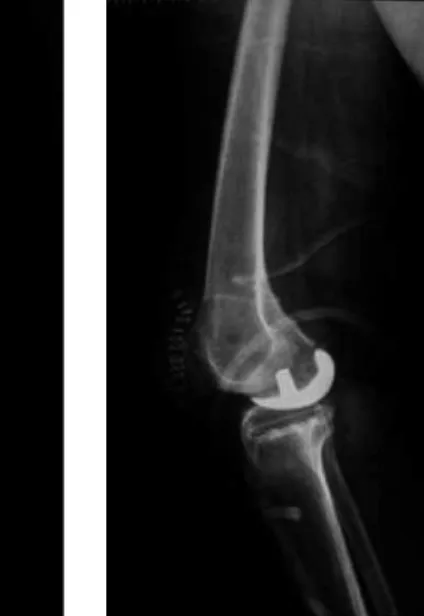Fig. 2b. 60-year-old male  patient lateral x-ray after the  operation.