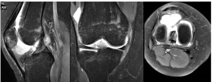 Fig. 2. A mass image seen T2 MRI both coronal,sagittal and axial views.