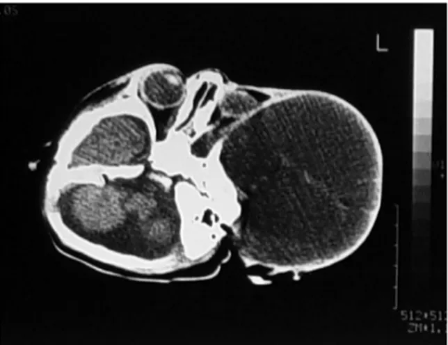 Figure 1b: CT showing a large heterogeneous cystic  mass displacing and distorting the anatomical  structures (left orbit, temporal fossa) in the same  patient 