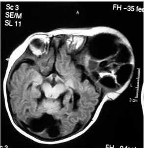 Figure 1d: After removal of the teratoma, a T1  weighted axial plane MRI showing no recurrence  and spontaneous reshaping of the compressed  skull