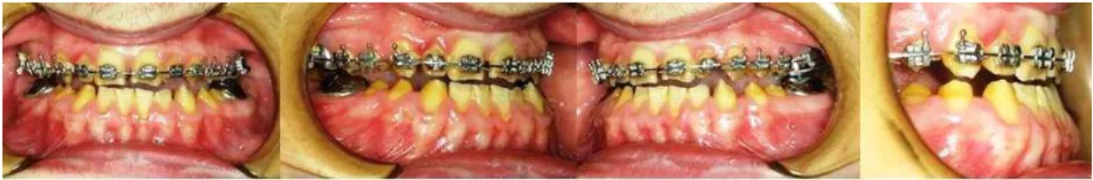 Figure 4. Post-treatment intra-oral photographs of the case 