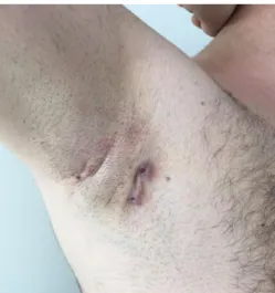 Figure 2.Fistula with two openings and atrophic scars on  the right axillary area at 3 months