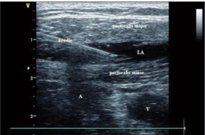 FIGURE 1: PECS block USG view.