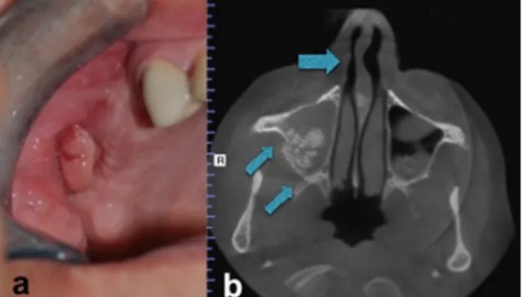 Figure 3. Intranasal endoscopic appearance.