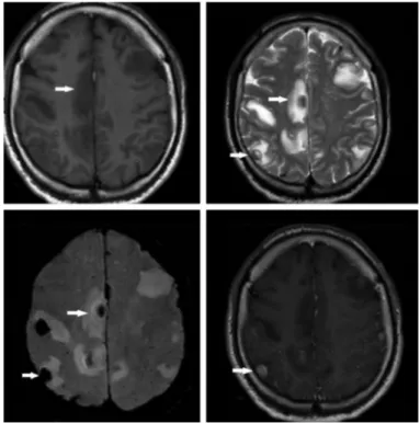 Figure 1.  Supra- and infratentorial, multiple malignant melanoma  metastases that showed susceptibility artifacts on VenoBOLD sequences  that were hyperintense on axial T1-weighted images and hypointense on  axial T2-weighted images