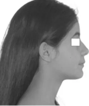 Figure 2. Facial appearance of a case with Class I occlusion.  