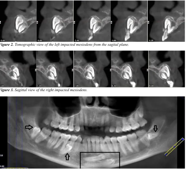Figure 2. Tomographic view of the left impacted mesiodens from the sagital plane.