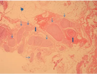 Figure 2. (Stained with hematoxylin and eosin, 40 x ) Neural  fibers surrounded by adipose tissue