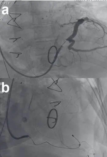 Figure  1.  Preoperative  12-lead  electrocardiogram  (eCG)  sho- sho-wing atrial fibrillation (a)