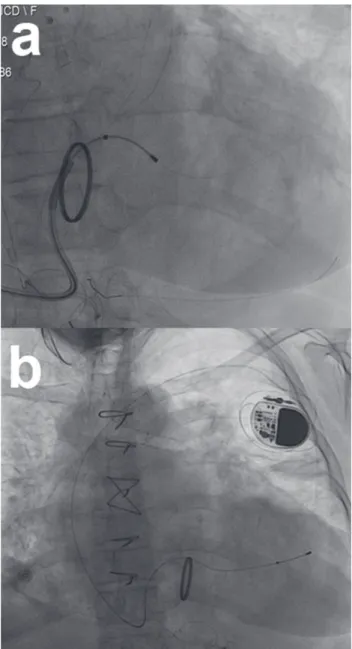 Figure 3. Coronary sinus (Cs) pacing lead advanced through pos- pos-terolateral brunch with support of Cs sheath and 5 F coronary  angiography catheter (a), Cs pacing lead positioned into  poste-rolateral brunch and connected to pacemaker generator (b).