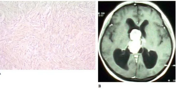 Figure 3: 3a, Moderate MMP-11 expression in a grade 1 transitional meningioma (MMP-11, x 200); 3b, an  axial cross-section contrast-enhanced T1 MRI of an intraventricular meningioma