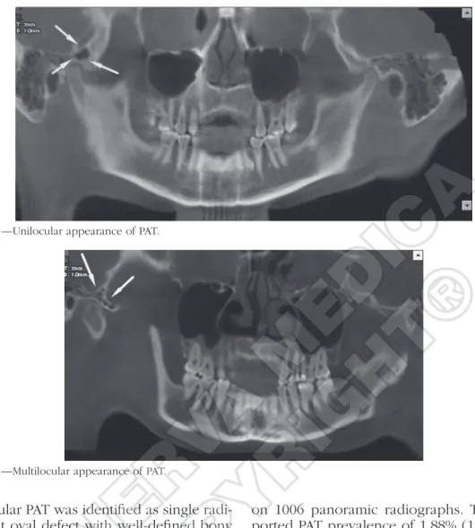 Figure 4.—Unilocular appearance of PAT.