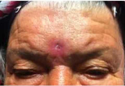 Figure 1. Non-tender erythema, induration and ulcer on the forehead 