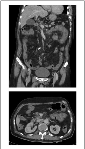 Figure 1 - Abdominal computerized tomography of the  patient on the second day of febrile neutropenic  ep-isode [Two-pointed black arrows show the increased  thickness of the jejunal wall (thickness 10 mm)].