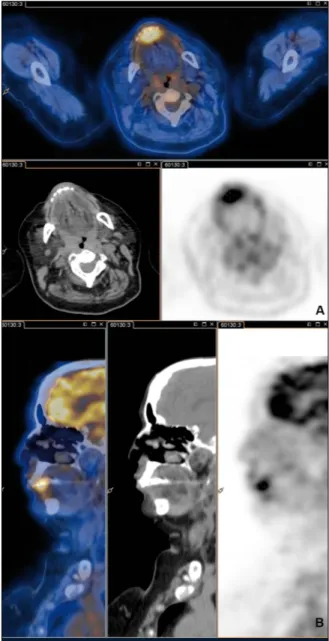 Figure 1 - PET/CT was performed to rule out any pos- pos-sible malignancy. Axial (A) and sagittal (B) images of  PET/CT are shown in the figure