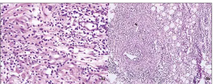 Figure 3 - Inflammatory cells consist of lymphocytes that display perivascular and interstitial distribution as well  as eosinophils (Figure 3a)