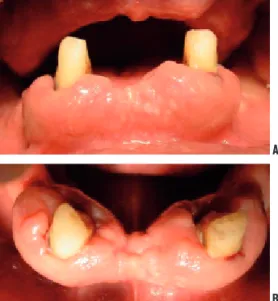 Figure 2A-B. Ten days after initial examination. Gingival ulcerations and gingival  bleeding were noted.