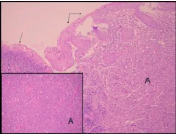 Figure 5. The ulceration (single arrow) in the squamous epithelium (double arrows) and  atypical myeloid cells beneath the epithelium (A) are seen in the photomicrograph