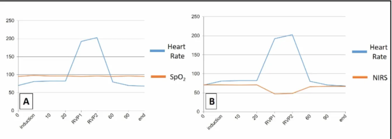 Figure 2. The systemic oxygen saturation (SpO 2 ) (A) and near-infrared spectroscopy (NIRS) values (B) during the rapid ventricular pacing (RVP) period of the TAVI procedure are demonstrated.