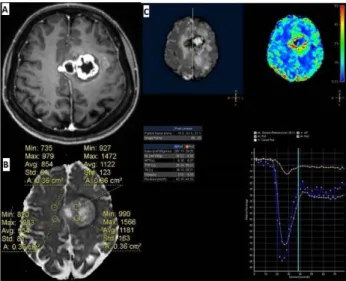 Figure 2. Glioblastoma. 