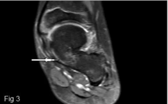 FIGURE 3. Coronal proton density (PD) fat saturated TSE image demonstrates the osseous connection with continuity of marrow fat from the talus to the calcaneus