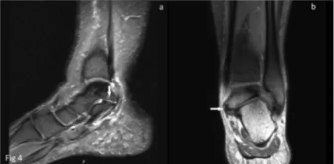 FIGURE 4. A) Coronal and B) Sagittal FS TSE PD images of the second patient show fibrocartilaginous talocalcaneal coalition (arrow) involving posterior facets of the subtalar joints.