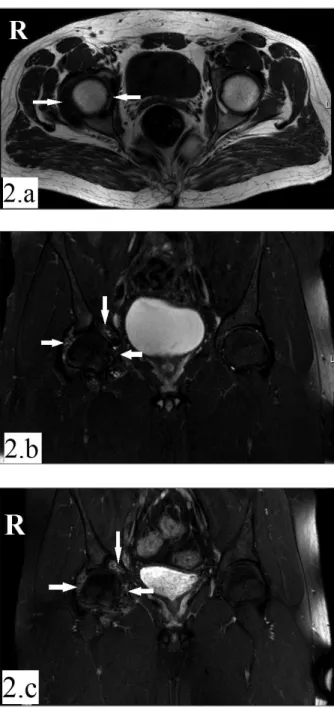 FIGURE 2. MRI of the right hip: Millimeter-sized, multiple intra-articular cartilaginous fragments, not all of which are ossified (white-arrows) can be seen on the axial-T1-sequence (a) and coronal-T2-sequence (b).They are  heterogeneous--hypointense and f