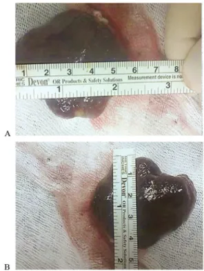 Figure 1. Left atrial myxoma (white arrow) seen on echocardiographic eval- eval-uation – four chamber view