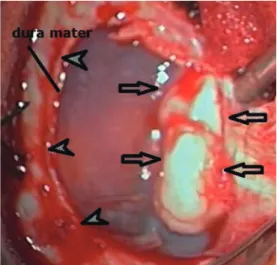 Fig. 3. Intraoperative  view  of  the  intracranial  and  extra-axial  chondroma  (arrows)  dissected  with the overlying dura mater (arrowheads).