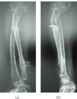 Figure 1: Anteroposterior (a) and lateral radiographs (b) of the patient’s forearm at initial admission