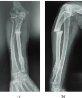 Figure 3: Forearm radiographs at the 6th week follow-up demonstrating the nonunion.