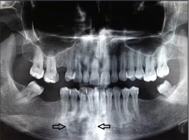 Figure 1. Ground-glass appearance of the lesion on panoramic  radiography.