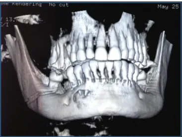 Figure 3A and 3B.  Whole  body scintigraphy revealed only  involvement of the mandible but not 